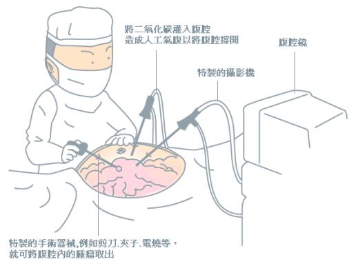 仁术创造奇迹 南方医院增城分院成功实施首例后腹腔镜下肾部分切除术