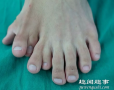 一足生9趾 罕见至极真相实在太让人惊愕
