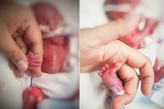 1斤多早產兒140多天“歷險”創奇跡