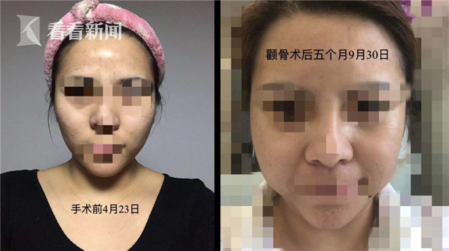手术前后对比_副本.png