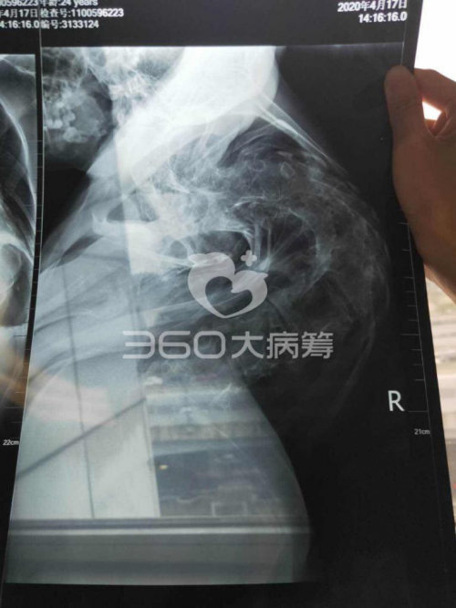 女婴罹患先天脊柱侧弯遭遗弃 25年后求助360大病筹期待奇迹