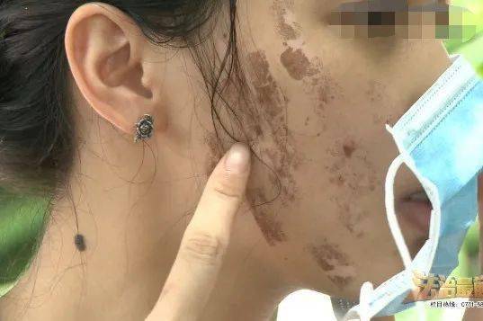 美团频陷医美事故纠纷 专家提醒：应注意医美行业特殊性