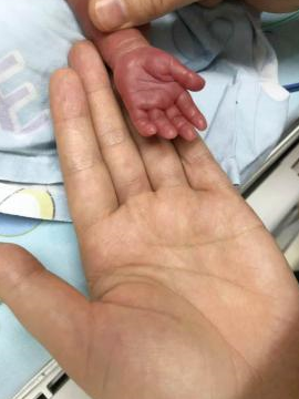 合肥这个宝宝创造了奇迹：出生时仅巴掌大